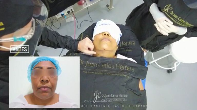 Liposucción de papada - Dr. Juan Carlos Herrera P.