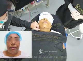 Liposucción de papada - Dr. Juan Carlos Herrera P.