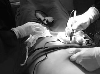 Micro Lipectomía - Dr. Johnatan L De Guevara