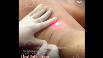 Lipólisis láser - Innova Laser Center