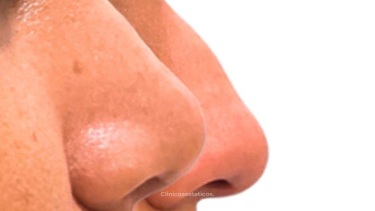 Rinoplastia - Doctora Alexandra Mora