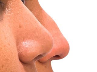 Rinoplastia - Doctora Alexandra Mora