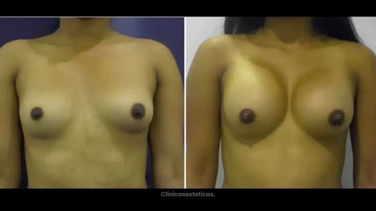 Mamoplastia de aumento - Dr. Gonzalez Legarda