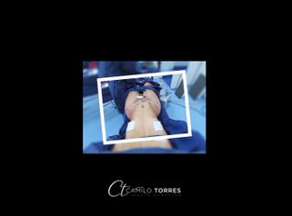 Gluteoplastia - Dr. Camilo Rafael Torres Rodríguez