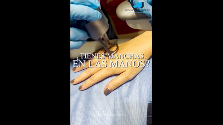 Manchas en la piel - Dr. Giancarlo Fajardo