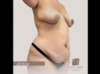 Abdominoplastia 