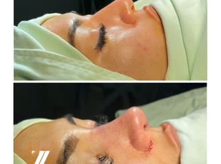 Rinoplastia - Dr. Zamir Páez