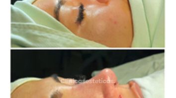 Rinoplastia - Dr. Zamir Páez