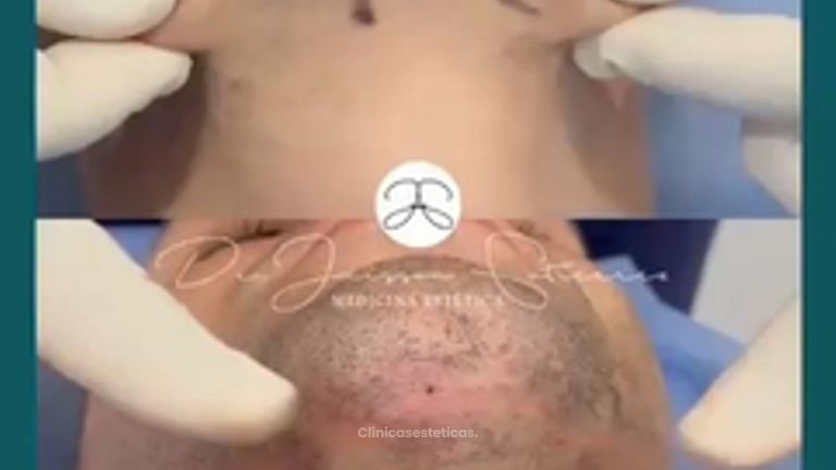 Lipopapada Endolifting - Dr. Jeisson Gutiérrez Cañas