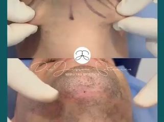 Lipopapada Endolifting - Dr. Jeisson Gutiérrez Cañas