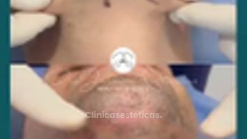Lipopapada Endolifting - Dr. Jeisson Gutiérrez Cañas