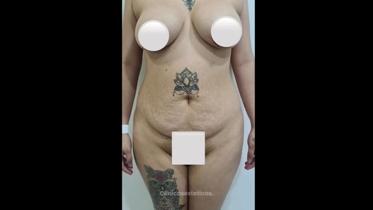 Abdominoplastia - Dra. Paola León