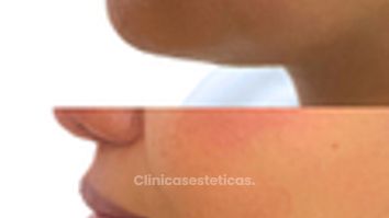 Radiesse en Mentón - Doctora Alexandra Mora