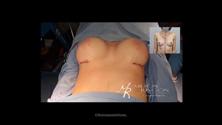 Mamoplastia de aumento - Dr. Milton Rincón Carranza