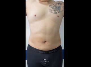 Liposucción - Dr. Luis Felipe Borda