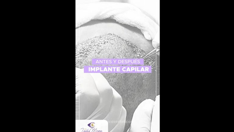 Implante capilar - Dra. Lady Mora y Dr. Juan Felipe Acosta