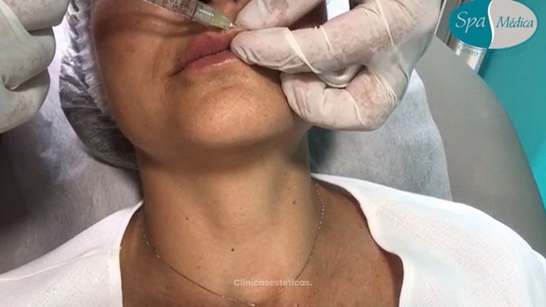 Aumento de labios - Dr. Juan Mario Escobar