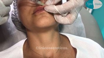 Aumento de labios - Dr. Juan Mario Escobar