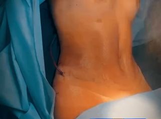 Lipoabdominoplastia más Mamoplastia de aumento - Clinica Vivir