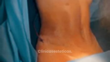 Lipoabdominoplastia más Mamoplastia de aumento - Clinica Vivir