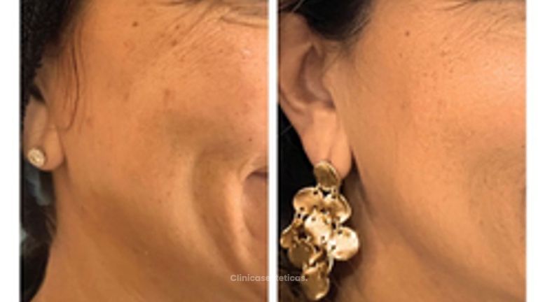 Bioestimulación en mejillas -Doctora Alexandra Mora