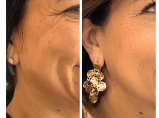 Bioestimulación en mejillas -Doctora Alexandra Mora