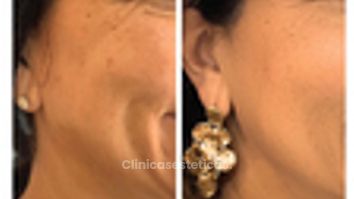 Bioestimulación en mejillas -Doctora Alexandra Mora