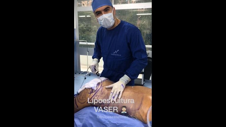 Lipoescultura - Tecnología Vaser