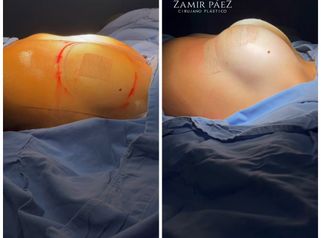 Mamoplastia de aumento - Dr. Zamir Páez