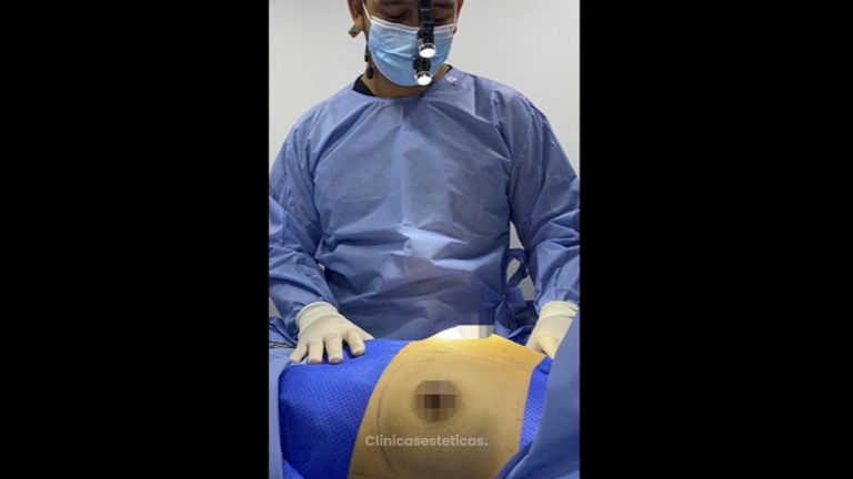 Mamoplastia de aumento - Dr. Luis Fernando Reyes & Dra. Nicole Echeverry
