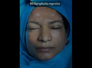 Blefaroplastia - Dr. Reinel Mesa