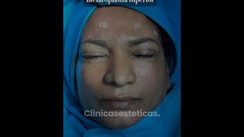 Blefaroplastia - Dr. Reinel Mesa