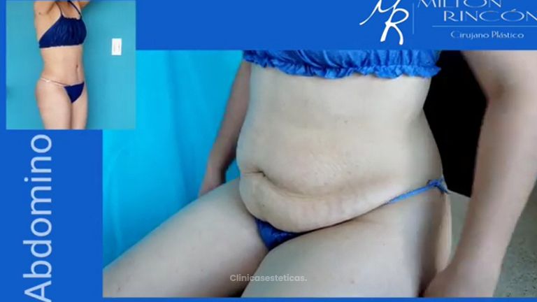 Abdominoplastia - Dr. Milton Rincón Carranza