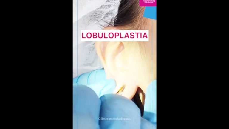 Lobuloplastia - Doctora Alexandra Mora
