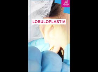 Lobuloplastia - Doctora Alexandra Mora