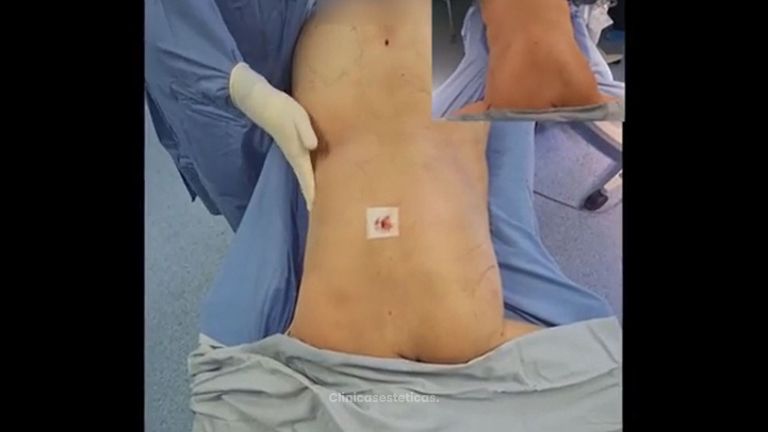 Liposucción - Dr. Milton Rincón Carranza