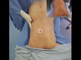 Liposucción - Dr. Milton Rincón Carranza