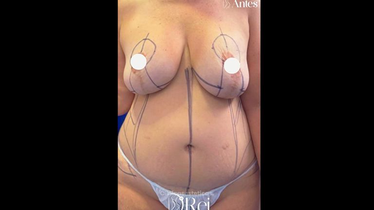 Lipoescultura - Dr. Reinel Mesa