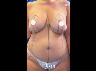 Lipoescultura - Dr. Reinel Mesa