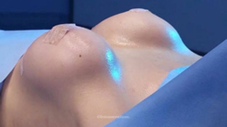 Mamoplastia en Aumento - Clinica Vivir