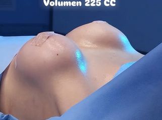Mamoplastia en Aumento - Clinica Vivir