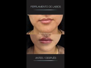 Aumento de labios - Dr. Miguel Ángel Cortés