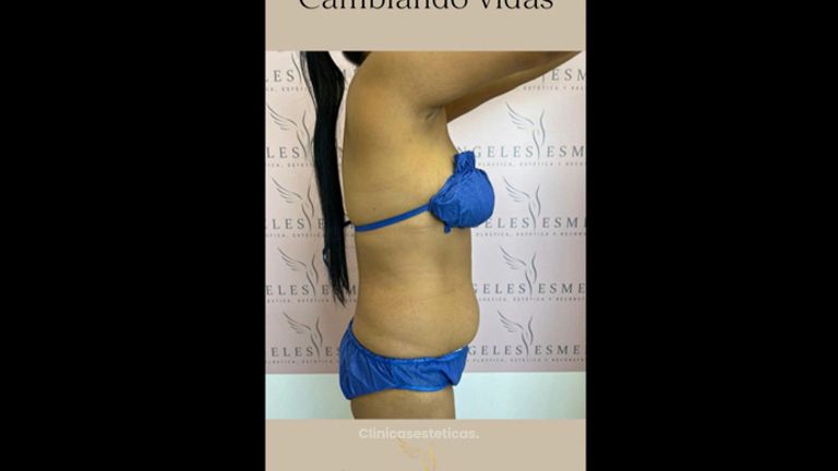 Lipoabdominoplastia - Dra. Claudia Cadavid