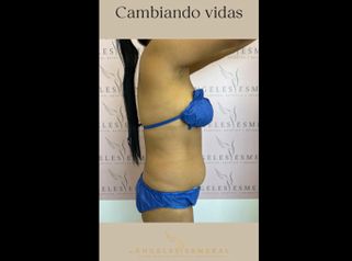 Lipoabdominoplastia - Dra. Claudia Cadavid