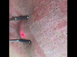 Láser CO2 para el Acné - Innova Laser Center