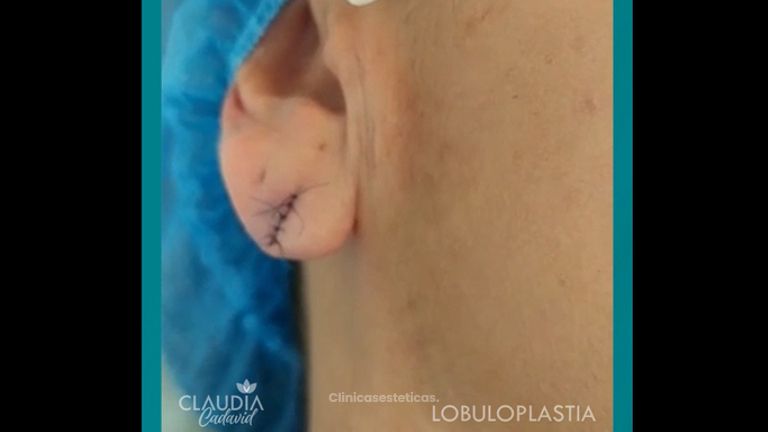Lobuloplastia - Dra. Claudia Cadavid