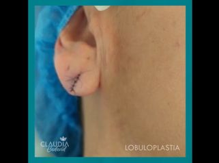 Lobuloplastia - Dra. Claudia Cadavid