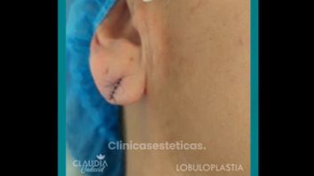 Lobuloplastia - Dra. Claudia Cadavid