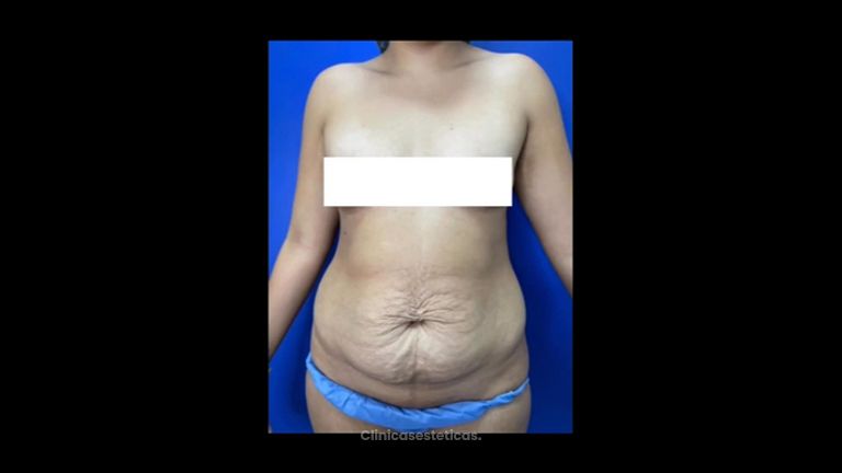 Liposucción - Dr. Carlos Zuleta Bechara