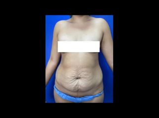 Liposucción - Dr. Carlos Zuleta Bechara